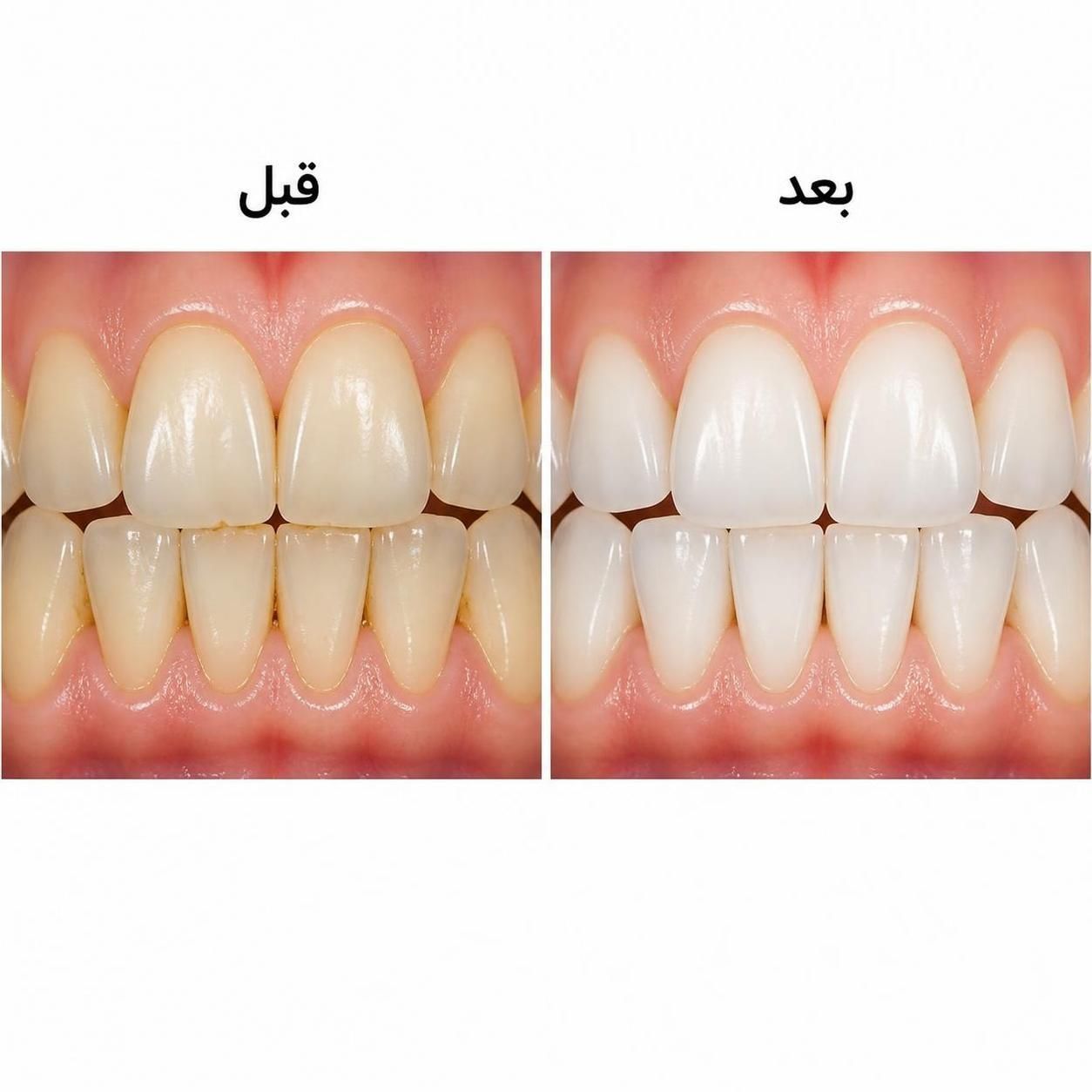 پکیج سرم سفید کننده دندان لانبنا  مسواک برقی شیائومی مدل X3 قابل شارژ ضدآب
